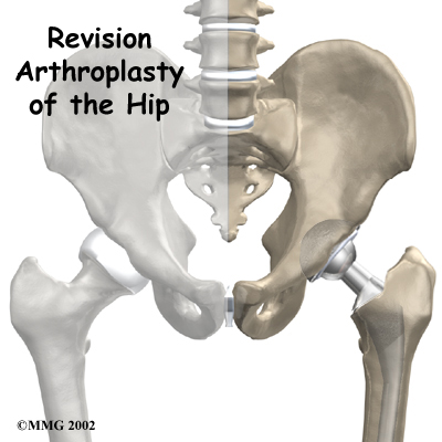 Revision Arthroplasty of the Hip